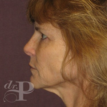 Case--30246 | Before Facelift and Neck Lift 3