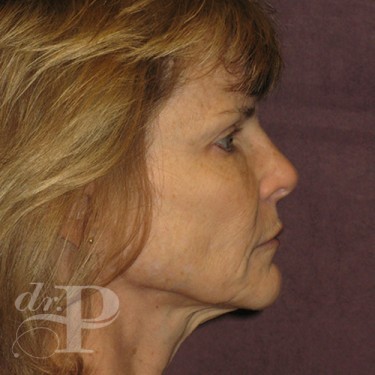 Case--30246 | Before Facelift and Neck Lift 5