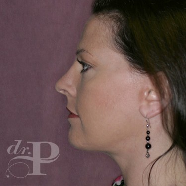 Case--29758 | After Facelift and Neck Lift 3
