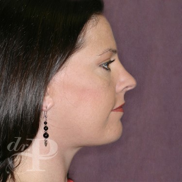 Case--29758 | After Facelift and Neck Lift 5