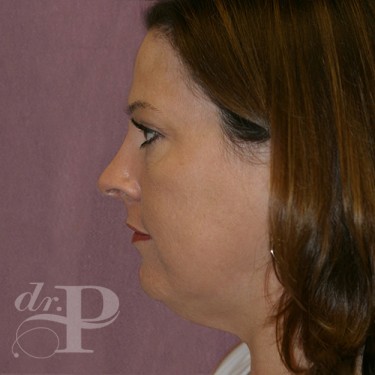 Case--29758 | Before Facelift and Neck Lift 3