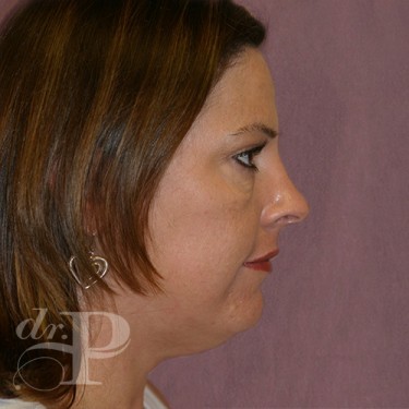 Case--29758 | Before Facelift and Neck Lift 5