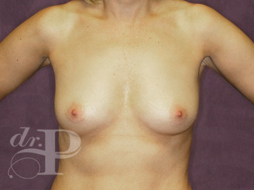 Case--29371 | Before Breast Augmentation 1