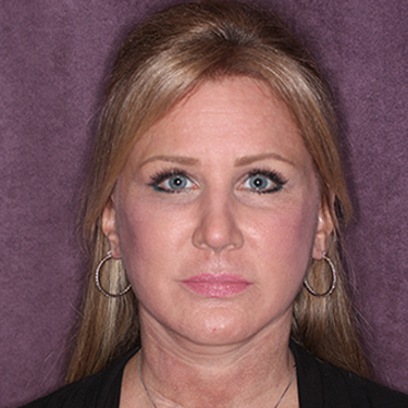 Case--34656 | After Facelift and Neck Lift 1