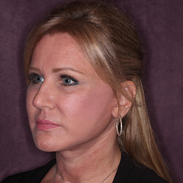 Case--34656 | After Facelift and Neck Lift 3