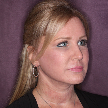 Case--34656 | After Facelift and Neck Lift 2