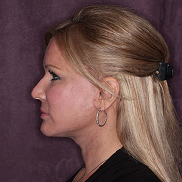 Case--34656 | After Facelift and Neck Lift 5