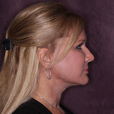 Case--34656 | After Facelift and Neck Lift 4