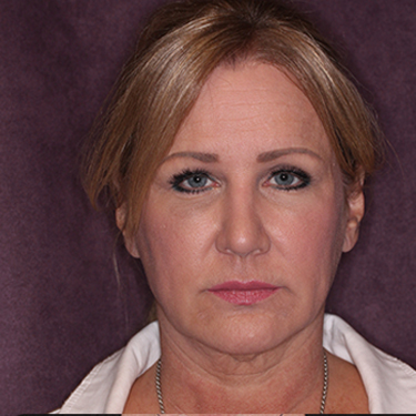 Case--34656 | Before Facelift and Neck Lift 1