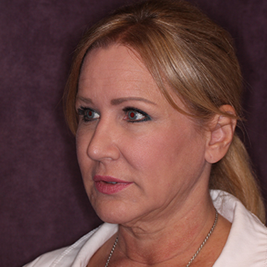 Case--34656 | Before Facelift and Neck Lift 3