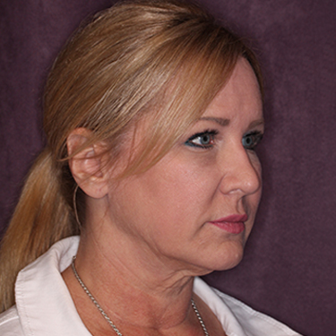 Case--34656 | Before Facelift and Neck Lift 2