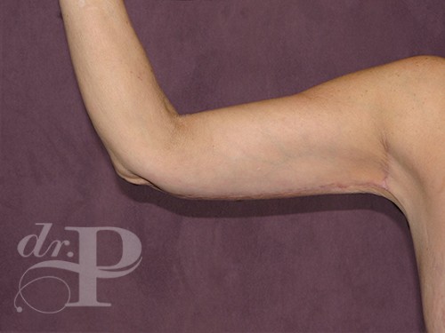 Case--29467 | After Arm Lift 1