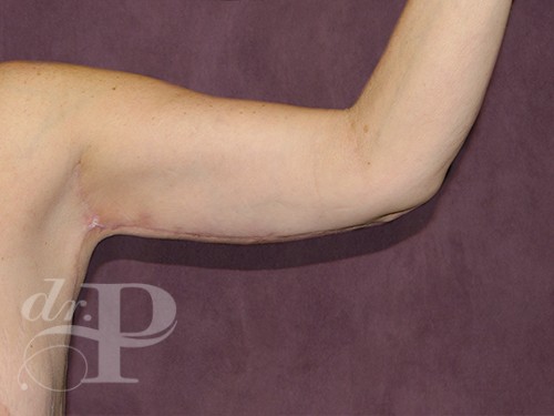 Case--29467 | After Arm Lift 2