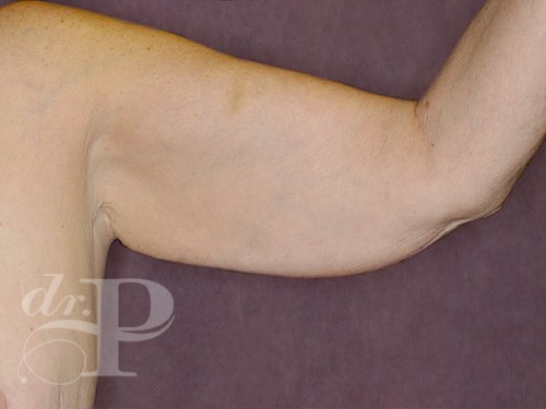 Case--29467 | Before Arm Lift 2