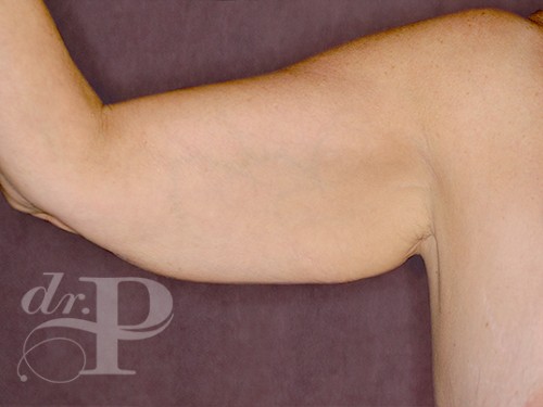 Case--29467 | Before Arm Lift 1