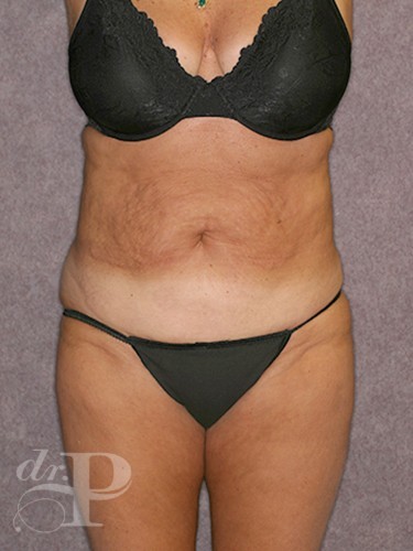Case--30298 | Before Lower Body Lift (Buttock Lift) 1