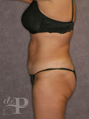 Case--1313 | Before Liposuction 3