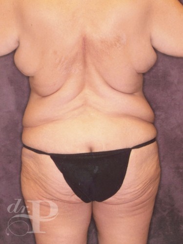 Case--30367 | Before True Form Tummy Tuck® in Overweight & Weight Loss Patients 3