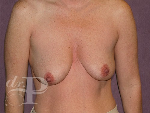 Case--29379 | Before Breast Augmentation and Breast Lift 1