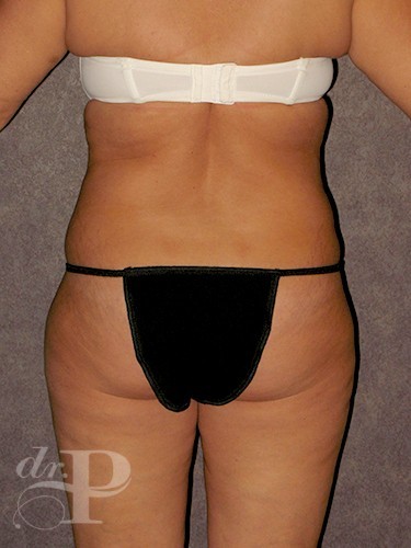 Case--29815 | Before Lower Body Lift (Buttock Lift) 3