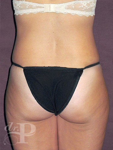 Case--1365 | Before True Form Tummy Tuck® 4