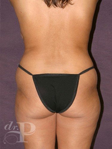 Case--1991 | Before True Form Tummy Tuck® 4