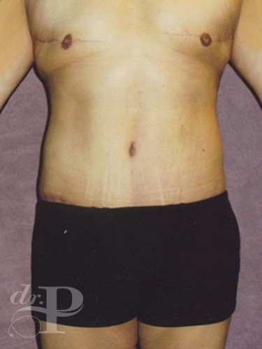 Case--1508 | After True Form Tummy Tuck® for Men 1