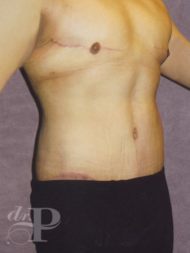Case--1516 | After Liposuction for Men 3