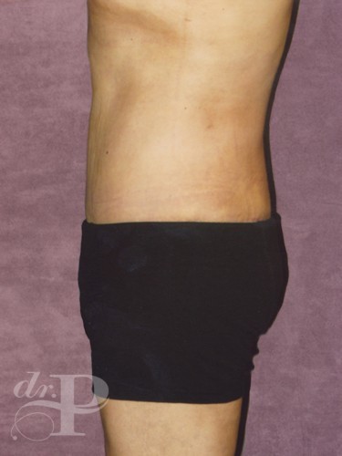 Case--1516 | After Liposuction for Men 2
