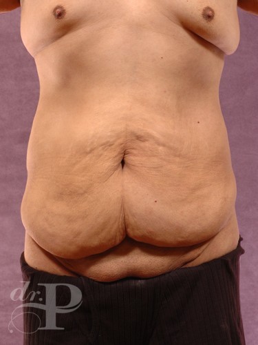 Case--30254 | Before Body Lift for Men 1