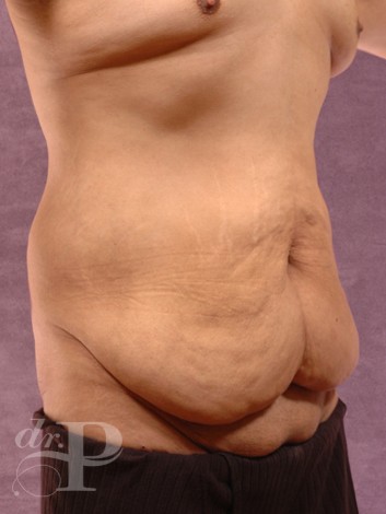 Case--1516 | Before Liposuction for Men 3