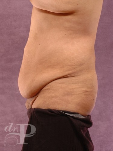 Case--1516 | Before Liposuction for Men 2