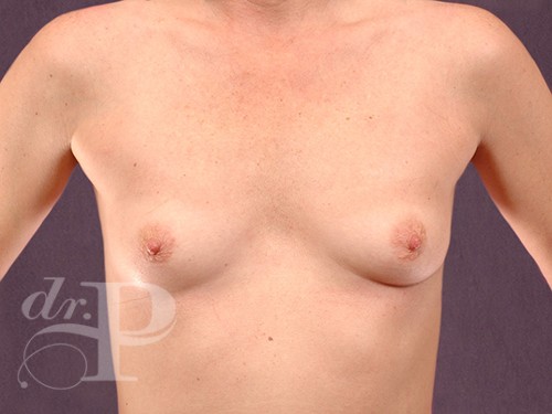 Case--28919 | Before Breast Augmentation 1