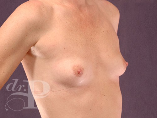 Case--28919 | Before Breast Augmentation 3
