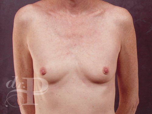 Case--28748 | Before Breast Augmentation 1