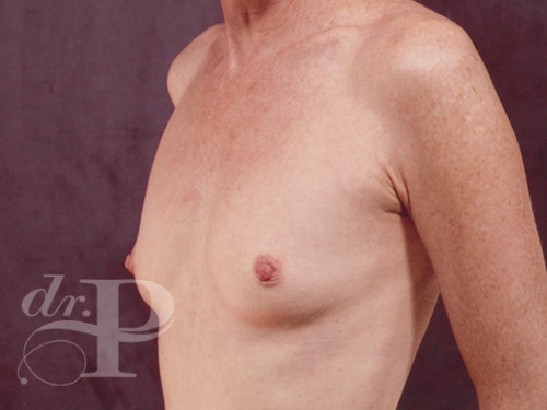 Case--28748 | Before Breast Augmentation 2