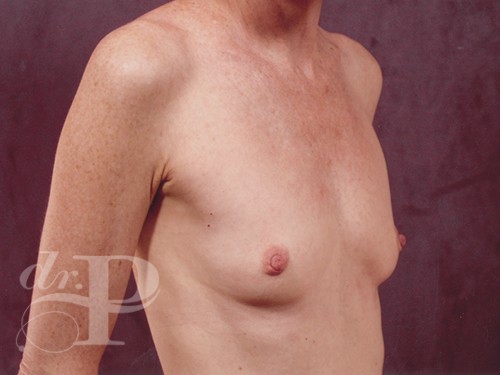 Case--28748 | Before Breast Augmentation 3