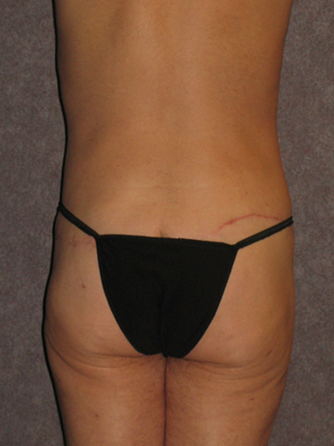 Case--33112 | After Body Lift for Men 4