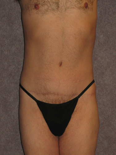 Case--33112 | After Body Lift for Men 1