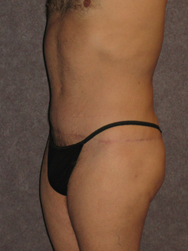 Case--33112 | After Body Lift for Men 2