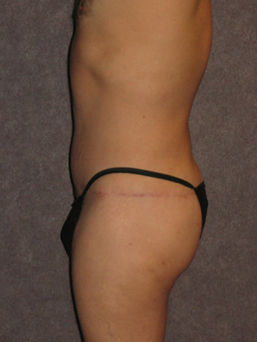 Case--33112 | After Body Lift for Men 3