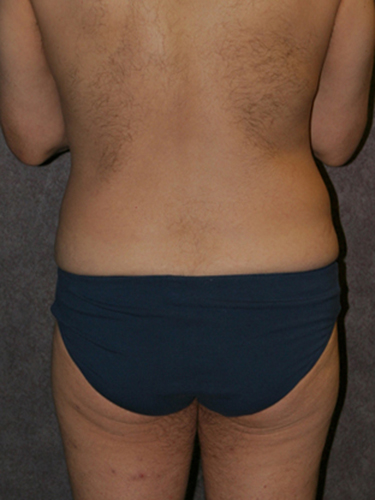 Case--33112 | Before Body Lift for Men 4