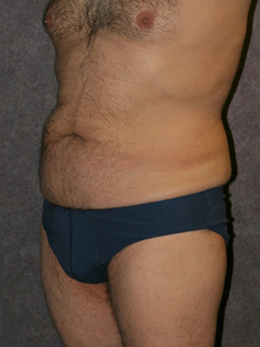 Case--33112 | Before Body Lift for Men 2