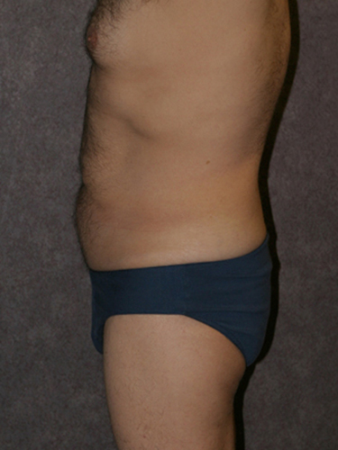 Case--33112 | Before Body Lift for Men 3