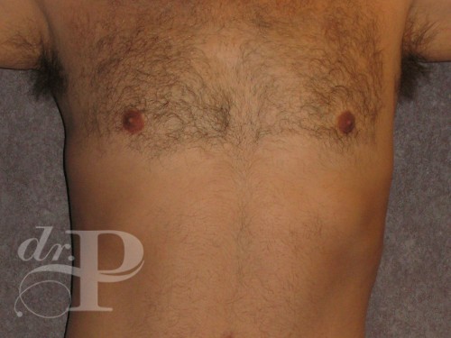 Case--29912 | After Gynecomastia 1
