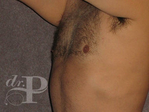 Case--29912 | After Gynecomastia 2