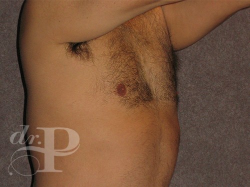 Case--29912 | After Gynecomastia 3