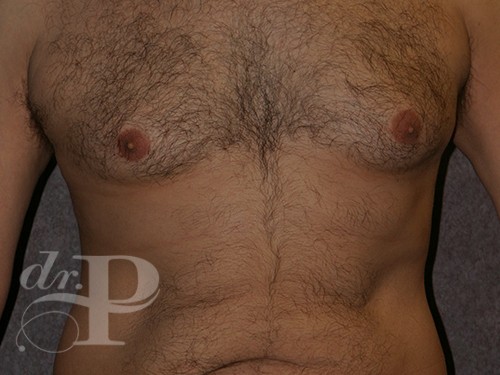 Case--29912 | Before Gynecomastia 1