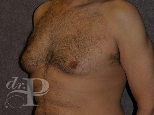 Case--29912 | Before Gynecomastia 2