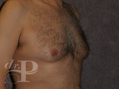 Case--29912 | Before Gynecomastia 3